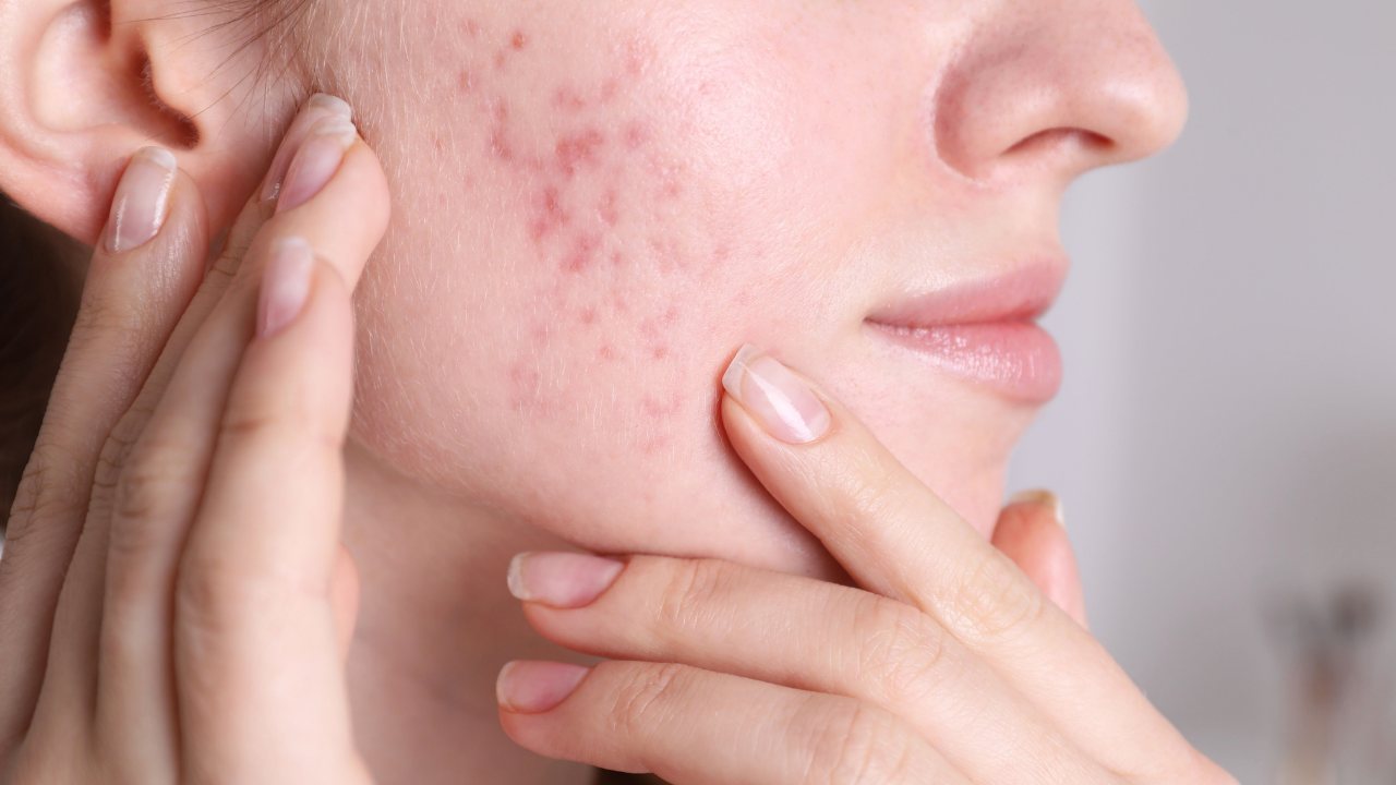 acne scarring